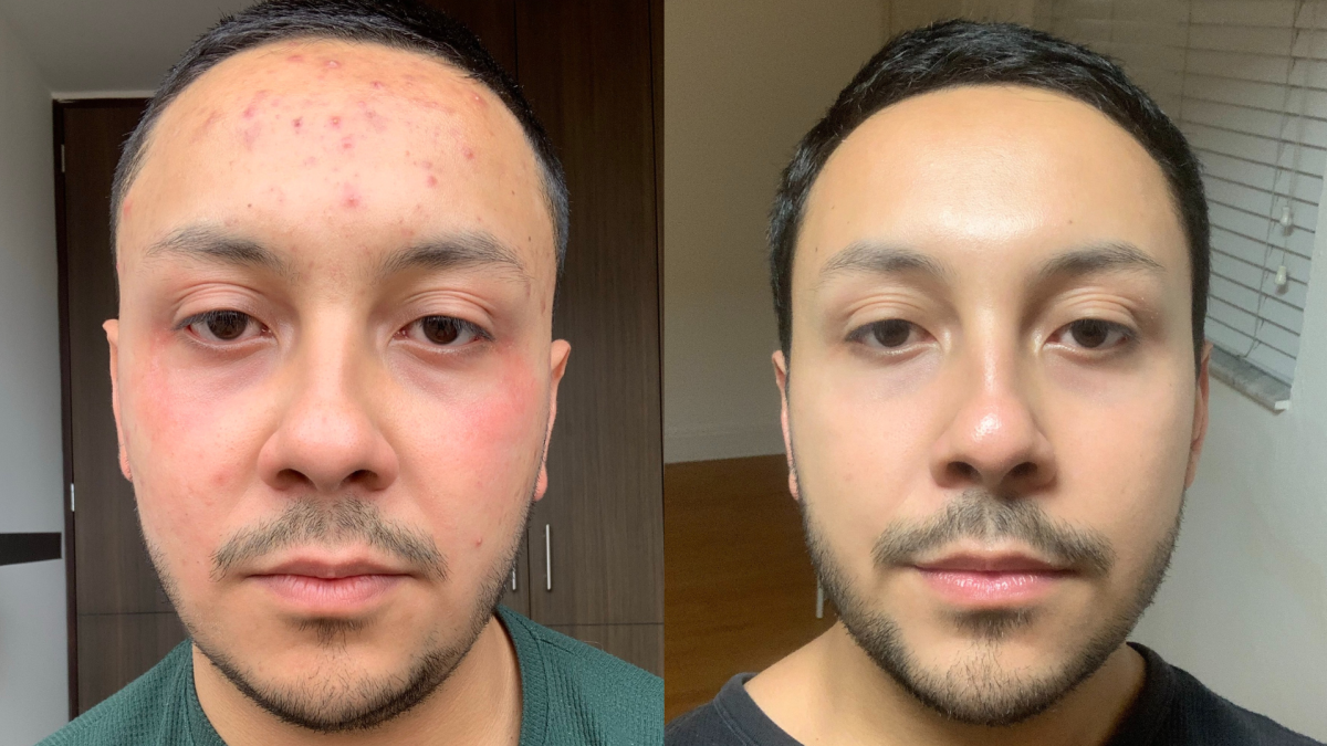 O que aprendi em minha desesperada busca por solução para acne severa
