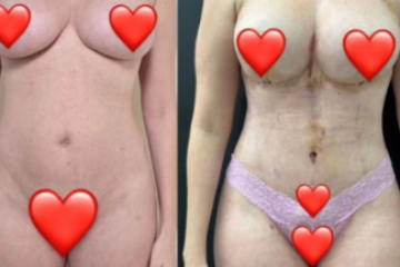Bárbara Evans mostra antes e depois de cirurgias plásticas