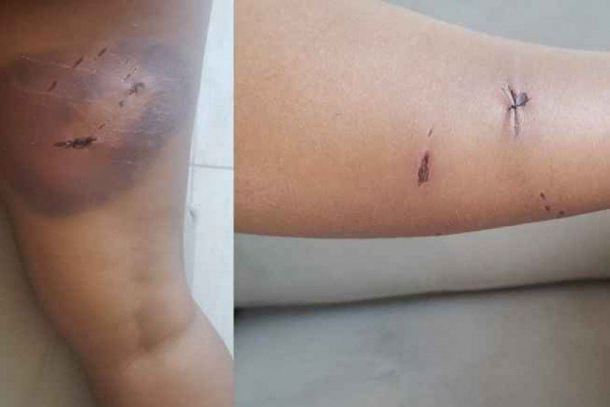 A servidora precisou levar pontos nos ferimentos