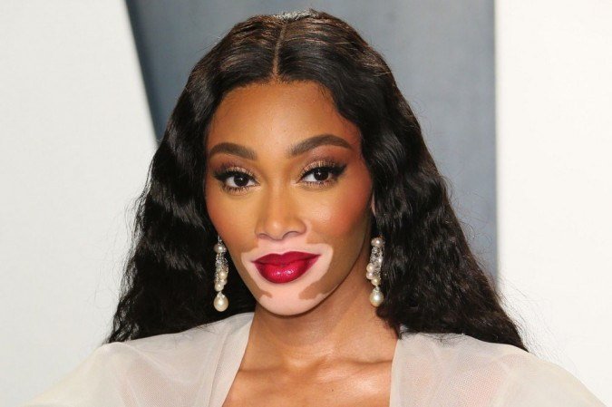A modelo Winnie Harlow, 26 anos, foi diagnostica aos 4 anos. A modelo Winnie Harlow, 26 anos, foi diagnostica aos 4 anos.