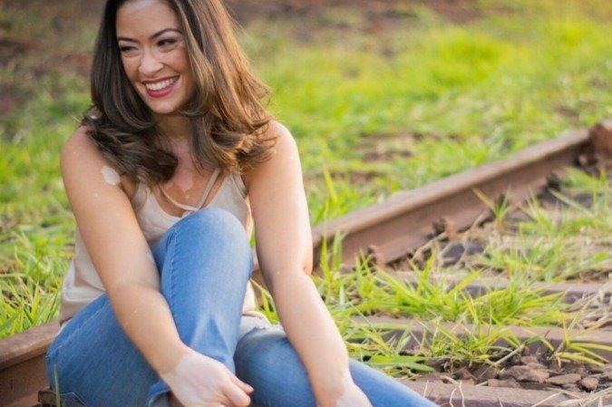 Maika Celi encampou uma luta nacional em favor das pessoas com vitiligo Maika Celi encampou uma luta nacional em favor das pessoas com vitiligo
