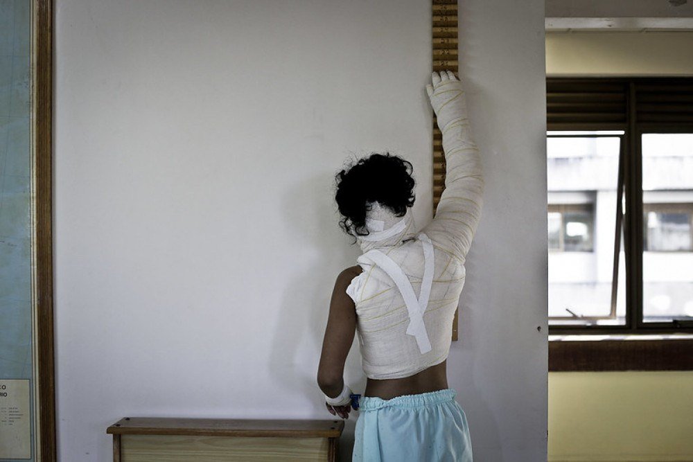 O Hran é referência no Centro-Oeste no tratamento de queimaduras. 