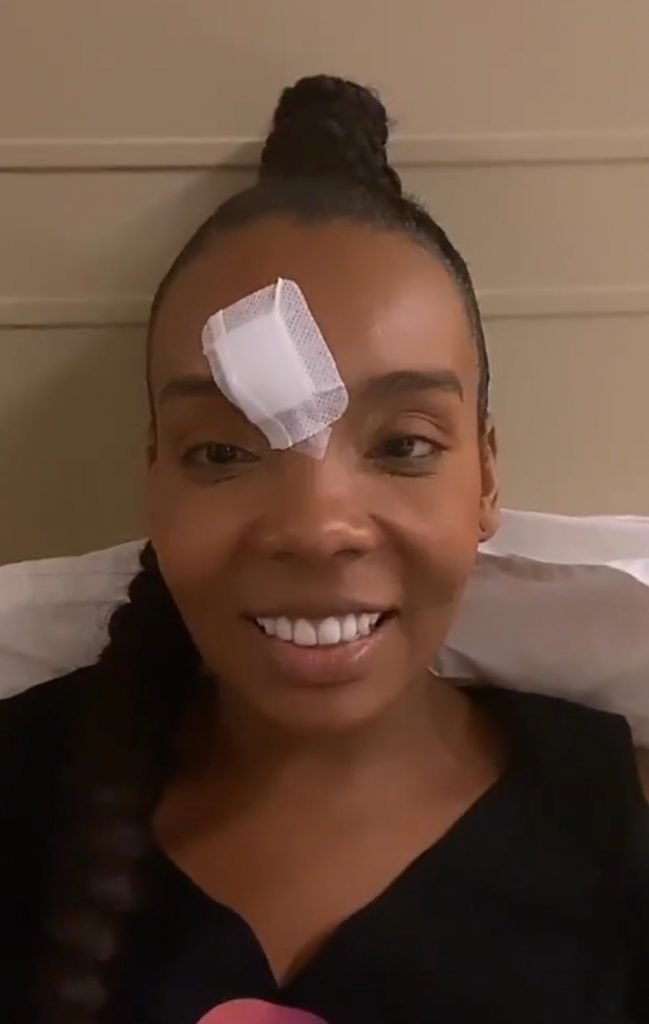 Thelma Assis com curativo após acidente no Criança Esperança 2020