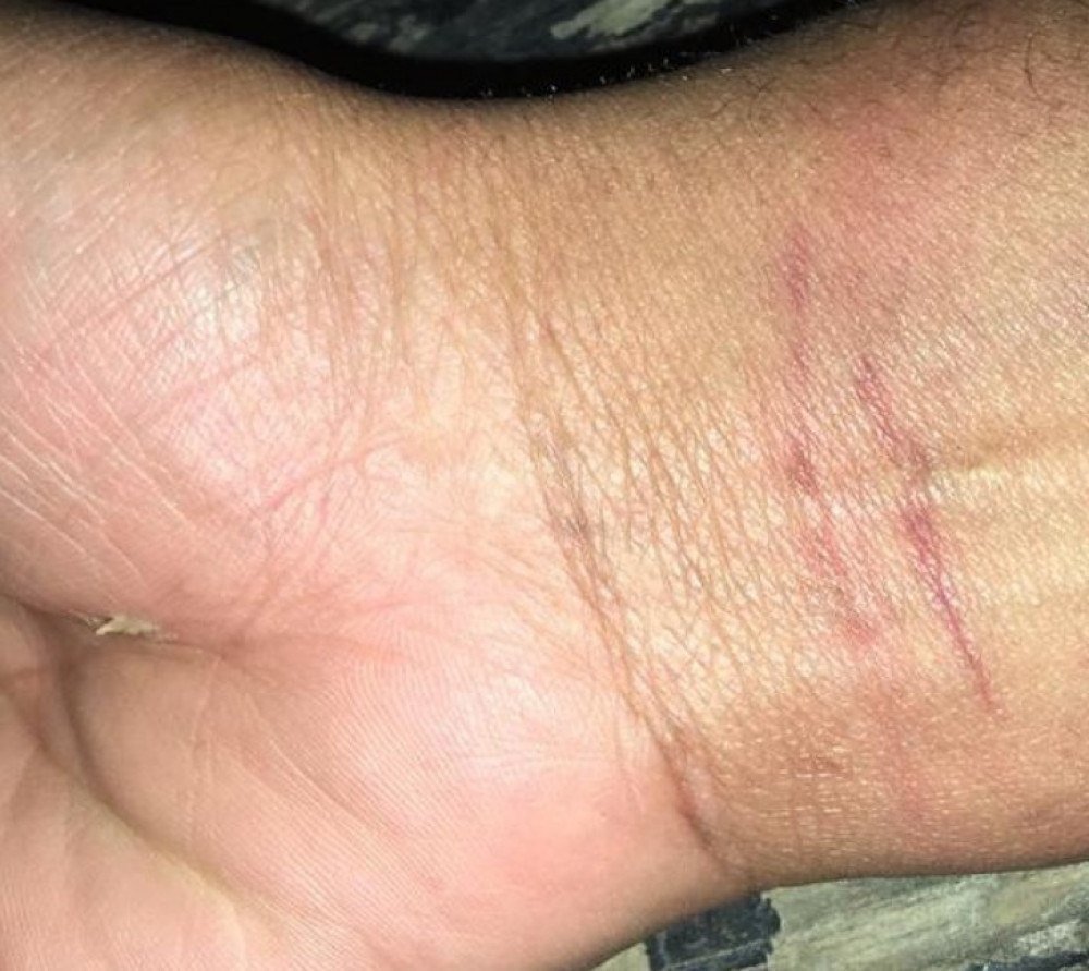 Exame do IML comprovou escoriações