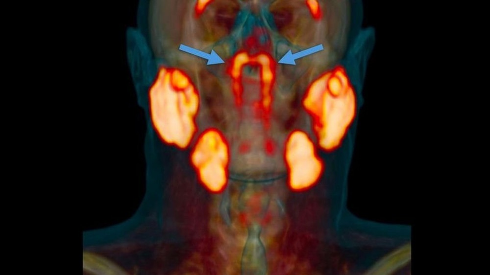 Cientistas dizem ter descoberto por acaso órgão misterioso na cabeça humana