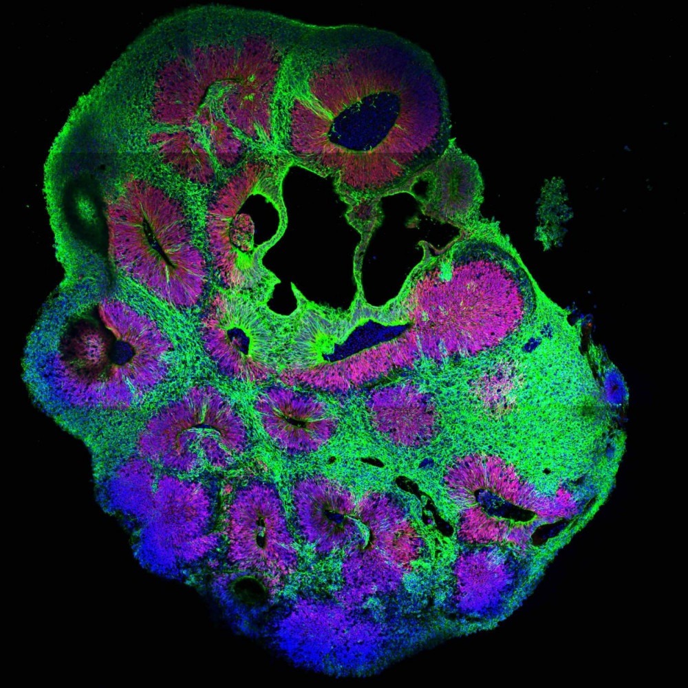 Técnica revolucionária identifica 25 genes ligados à microcefalia