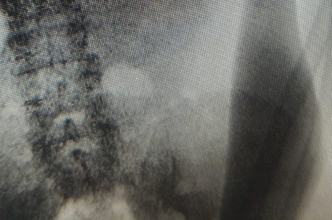 Drogas e dinheiro foram encontrados dentro da barriga de um interno