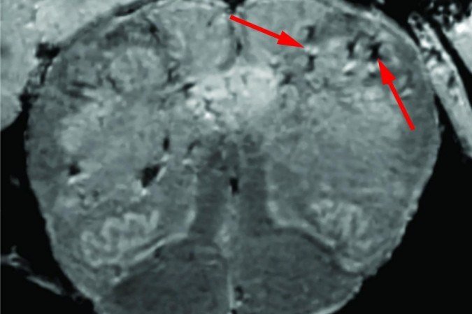 Pontos claros e escuros marcados pelas setas demonstram os danos cerebrais em pacientes com covid-19 - (crédito: NIH/NINDS/Divulgação) Pontos claros e escuros marcados pelas setas demonstram os danos cerebrais em pacientes com covid-19 - (crédito: NIH/NINDS/Divulgação)