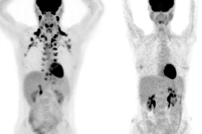 Em pet scan, é possível ver que a pessoa da esquerda tem mais gordura marrom que a da direita - (crédito: Andreas G. Wibmer e Heiko Schöder/Divulgação) Em pet scan, é possível ver que a pessoa da esquerda tem mais gordura marrom que a da direita - (crédito: Andreas G. Wibmer e Heiko Schöder/Divulgação)