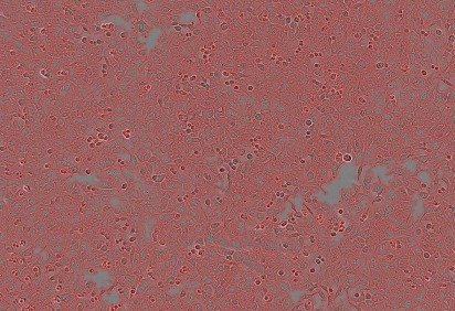 Células de câncer observadas pelo microscópio - (crédito: Universidade de Tel Aviv/Divulgação) Células de câncer observadas pelo microscópio - (crédito: Universidade de Tel Aviv/Divulgação)