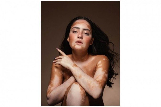 Larissa Sampaio passou 13 anos escondendo o vitiligo: feliz no papel de inspiradora de outras pessoas