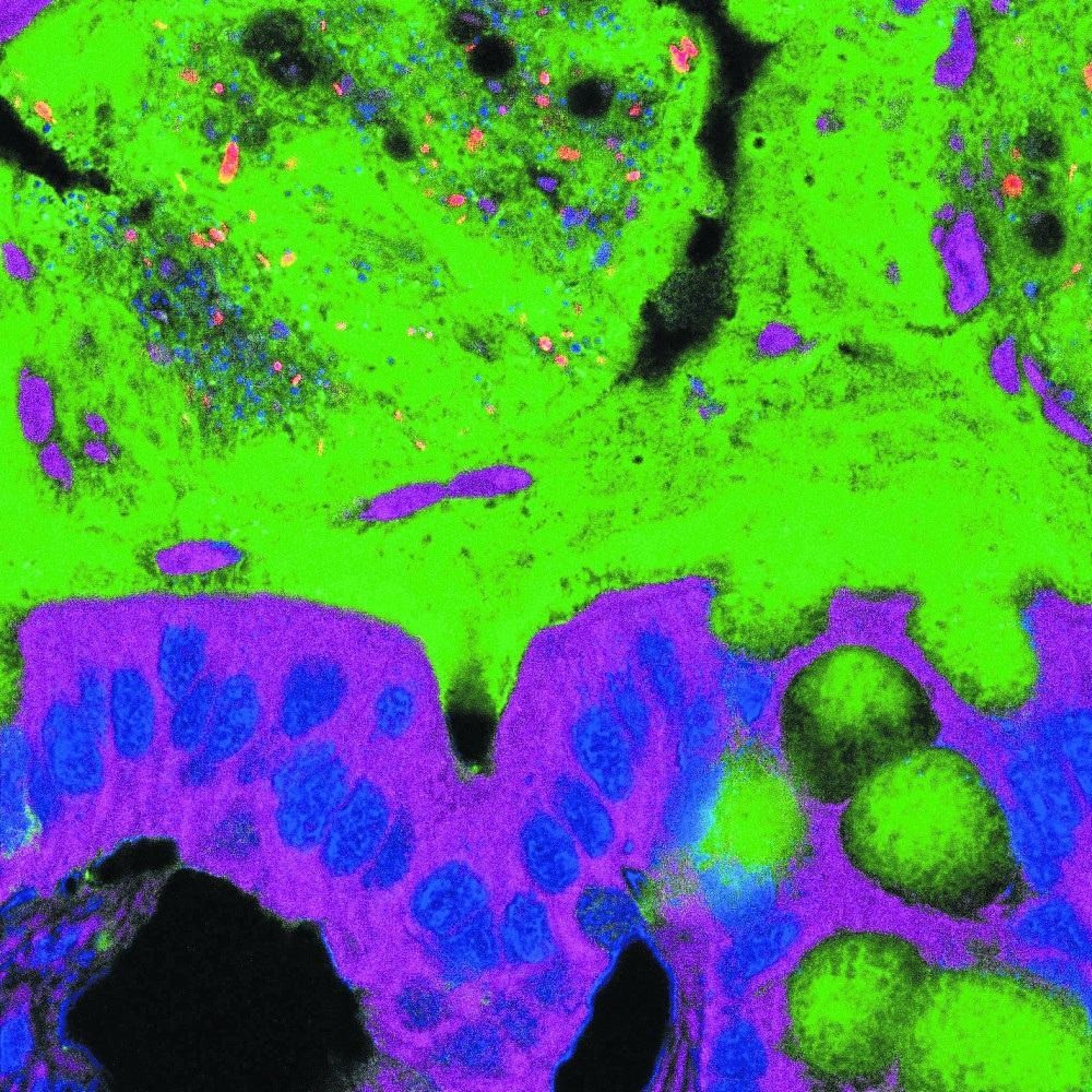 Forma grave da covid-19 pode causar malefícios à microbiota humana