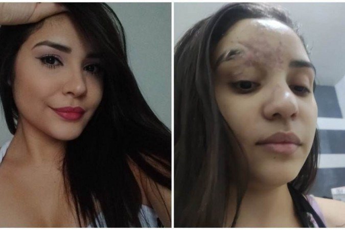 A universitária passará por avaliação para dar início aos procedimentos necessários para a terceira cirurgia no rosto, além de realizar sessões de fisioterapia para ajudar na cicatrização -  (crédito: Kedydja Borges)