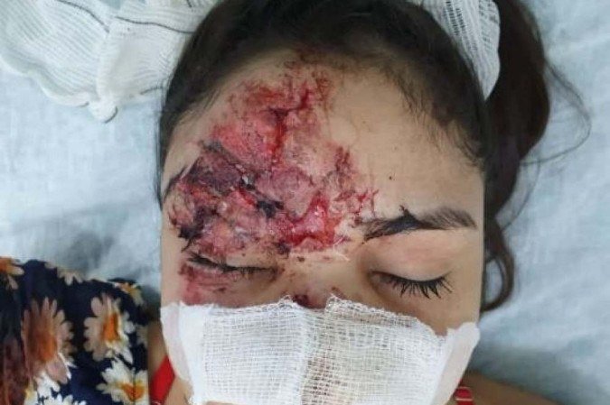 Rosto da estudante no dia do acidente, em 16 de novembro de 2020. Ela abriu a testa, vidros foram encostados embaixo do couro cabeludo e o nariz foi destruído