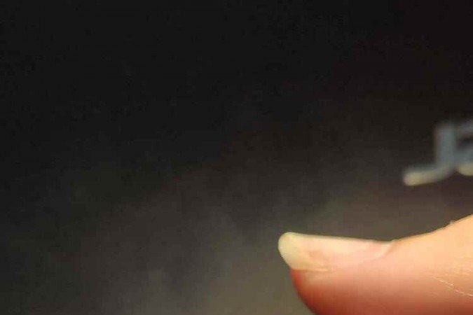 Pedaço de vidro encontrado por cirurgião no nariz de Kedydja sete meses após o acidente. Ela sentia dificuldade em respirar mas não sabia que o resquício era o motivo