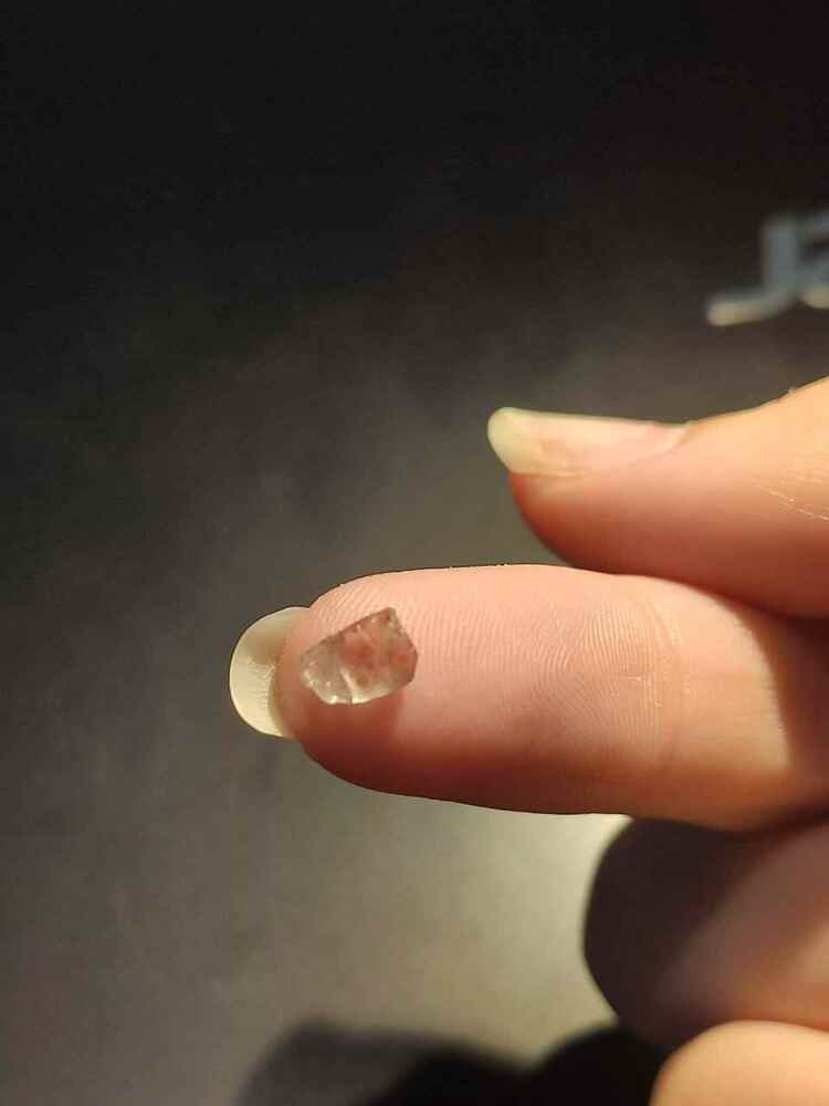 Pedaço de vidro encontrado por cirurgião no nariz de Kedydja sete meses após o acidente. Ela sentia dificuldade em respirar mas não sabia que o resquício era o motivo