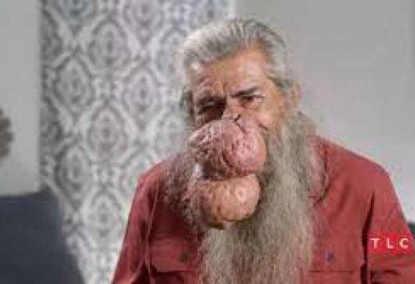 Americano faz cirurgia para retirar espinha de 11 anos; veja transformação