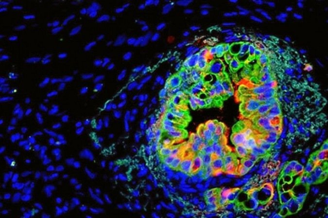 Célula de câncer pancreático: estudo ajuda a explicar por que, mesmo com mutações, algumas estruturas não adoecem - (crédito: Dawn Jaquish, UC San Diego/Divulgação) Célula de câncer pancreático: estudo ajuda a explicar por que, mesmo com mutações, algumas estruturas não adoecem - (crédito: Dawn Jaquish, UC San Diego/Divulgação)