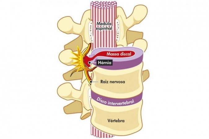Hérnia de Disco Foraminal e Seu Impacto na Coluna Vertebral