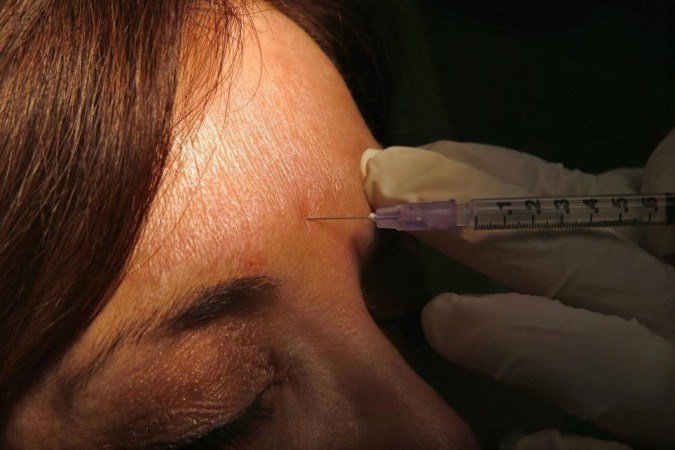 O uso da toxina botulínica para fins estéticos foi descoberto por acaso: quase duas décadas de sucesso - (crédito: Mike Segar/Reuters) O uso da toxina botulínica para fins estéticos foi descoberto por acaso: quase duas décadas de sucesso - (crédito: Mike Segar/Reuters)