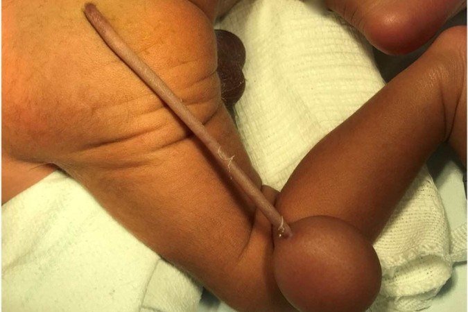 Em toda a literatura mundial, somente 40 casos do tipo foram relatados: a identificação em uma publicação de tamanha importância de um caso no Brasil ajuda a levantar mais conhecimentos - (crédito: Reprodução/Journal of Pediatric Surgery Case Reports) Em toda a literatura mundial, somente 40 casos do tipo foram relatados: a identificação em uma publicação de tamanha importância de um caso no Brasil ajuda a levantar mais conhecimentos - (crédito: Reprodução/Journal of Pediatric Surgery Case Reports)