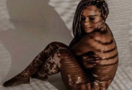 Vitiligo: entenda a doença de Natália Deodato, participante do BBB22