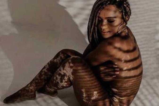 Entenda tudo sobre a doença da nova participante do BBB-22. Vitiligo é uma doença autoimune e não contagiosa -  (crédito: Instagram Natália Deodato/Divulgação)