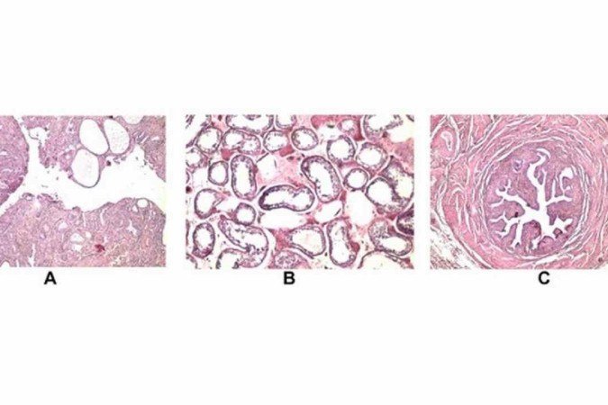 Útero e endométrio (A); Tuba e epidídimo (B) e testículo (C) descobertos em paciente durante cirugia de hérnia - (crédito: Reprodução/Urology Case Reports) Útero e endométrio (A); Tuba e epidídimo (B) e testículo (C) descobertos em paciente durante cirugia de hérnia - (crédito: Reprodução/Urology Case Reports)