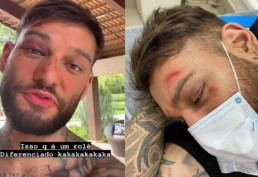 Lucas Lucco surge com o rosto desfigurado nas redes sociais e culpa bebida