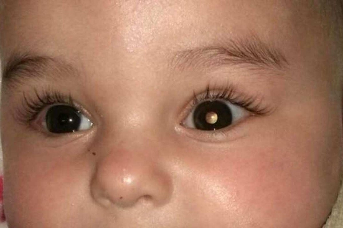 Retinoblastoma, um câncer raro que pode ocorrer nos olhos das crianças -  Blog Saúde Infantil