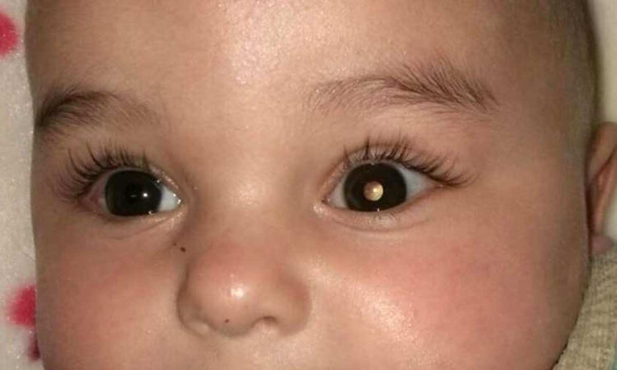 Retinoblastoma: uma doença genética