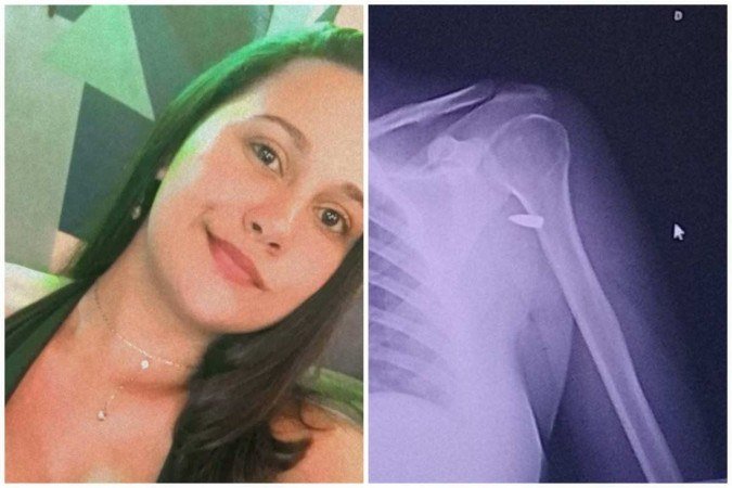 Renata Assis foi aconselhada pelos médicos a não remover a bala, pois o projétil está próximo a um nervo que pode fazê-la perder os movimentos, caso seja atingido - (crédito: Twitter/Reprodução) Renata Assis foi aconselhada pelos médicos a não remover a bala, pois o projétil está próximo a um nervo que pode fazê-la perder os movimentos, caso seja atingido - (crédito: Twitter/Reprodução)