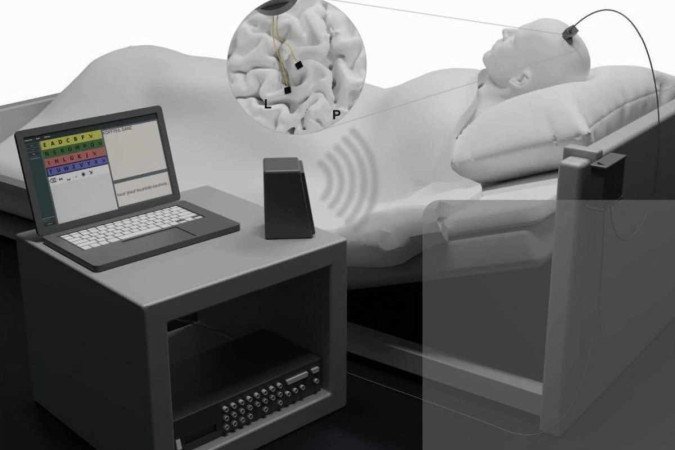 Reprodução artística de paciente com ELA que recebeu implante de microchips no cérebro  e voltou a se comunicar com a família 