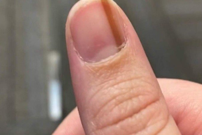 Estatisticamente, esse tipo de tumor corresponde a apenas 0,7% a 3,5% dos casos de melanoma - (crédito: @invrfoundwaldo/TikTok/Reprodução) Estatisticamente, esse tipo de tumor corresponde a apenas 0,7% a 3,5% dos casos de melanoma - (crédito: @invrfoundwaldo/TikTok/Reprodução)
