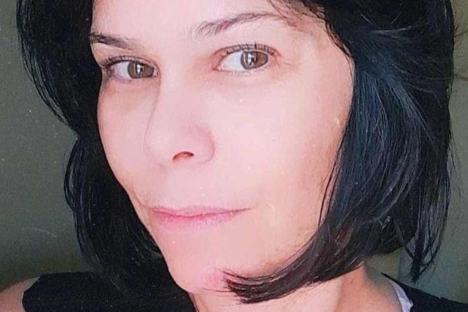 Mônica antes e depois do preenchimento labial