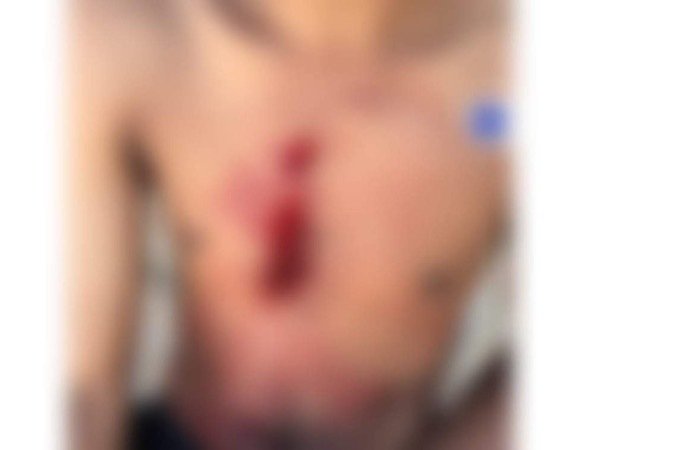 Jovem levou uma facada no tórax e foi levado ao hospital - (crédito: Material cedido ao Correio) Jovem levou uma facada no tórax e foi levado ao hospital - (crédito: Material cedido ao Correio)