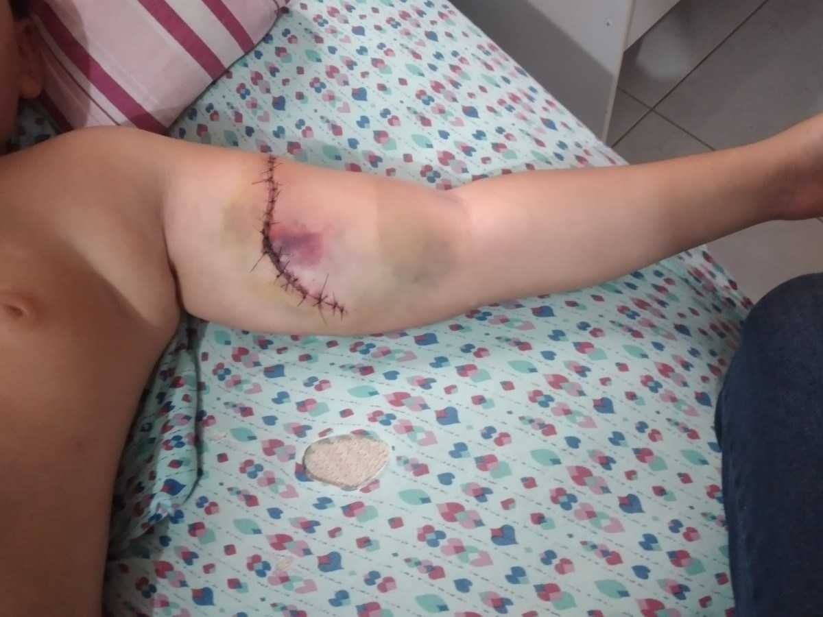 Estudante rasga braço em quadra de escola do DF e leva 19 pontos