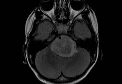  (crédito:  Michelle Monje, M.D., Ph.D., Sta)
