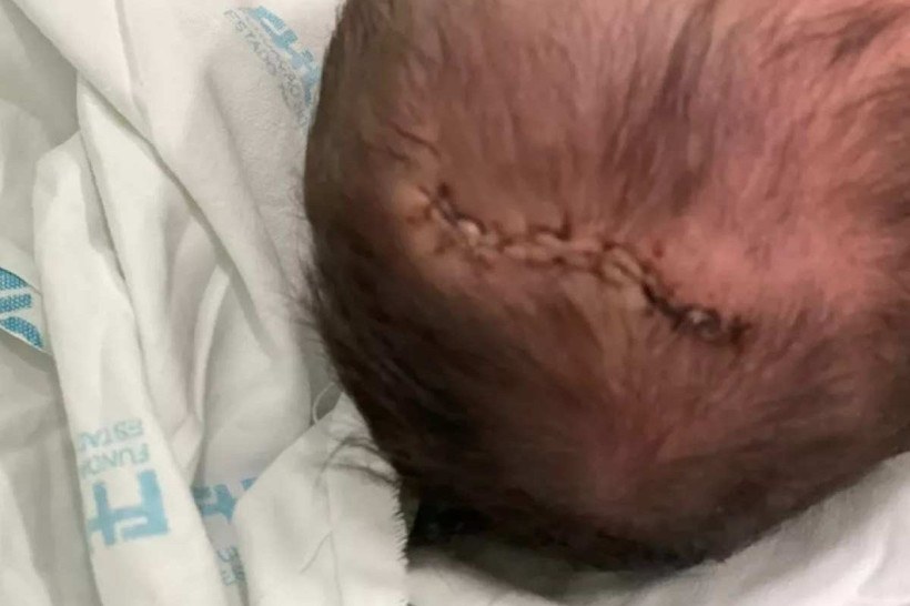 Recém-nascida sofre traumatismo craniano após queda em parto em BH