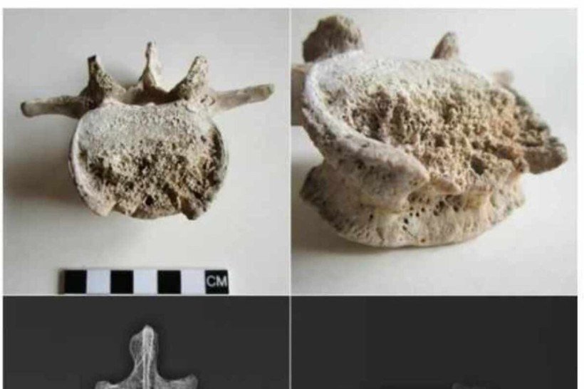 Fotografia e radiografia digital da quarta vértebra lombar (L4) acometida por espondilodiscite tuberculosa do indivíduo A.
