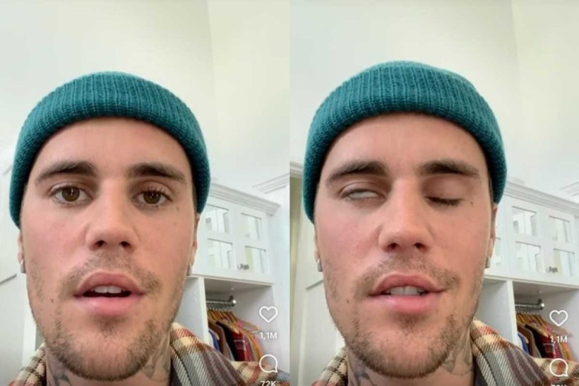 Justin Bieber aparece com metade do rosto paralisado: 