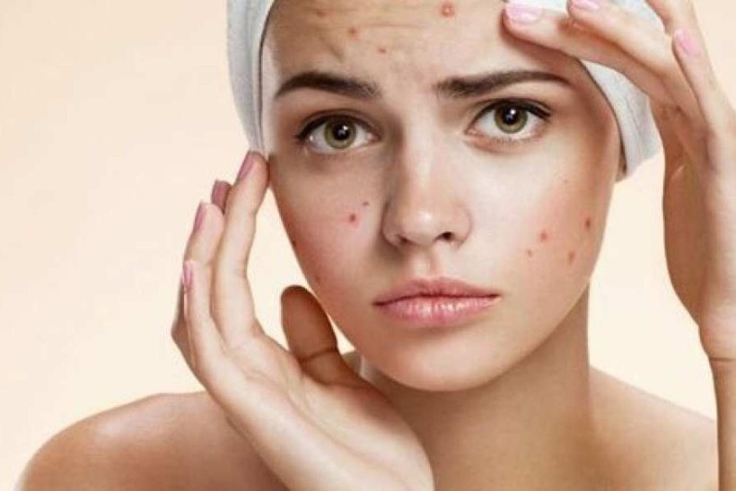 Conheça as principais causas da acne e os tratamentos recomendados
