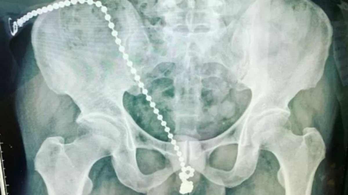 Homem precisa de cirurgia no pênis após introduzir corrente na uretra