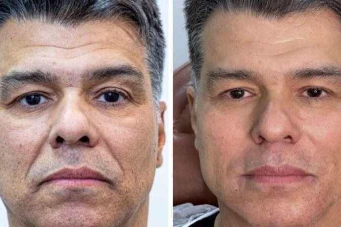 Maurício Mattar faz harmonização facial e mostra antes e depois