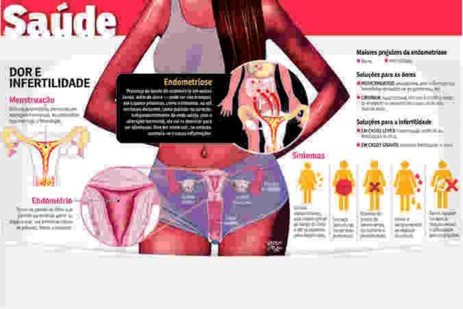 22-07-2022-S-Endometriose