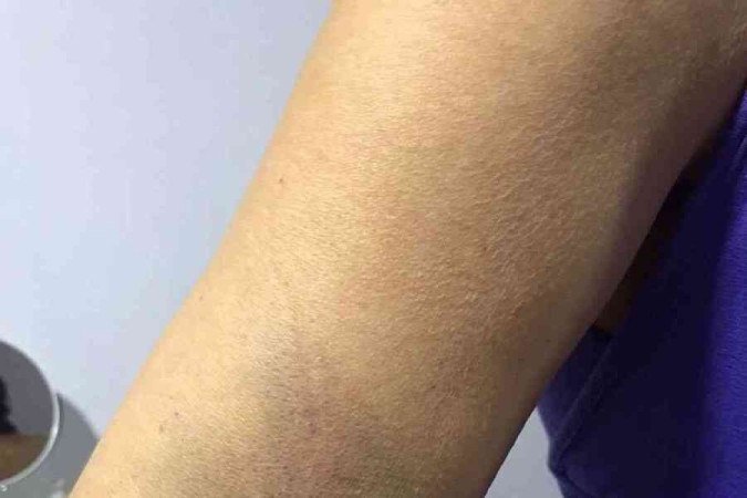 Mulher agredida pelo namorado mostra as marcas.