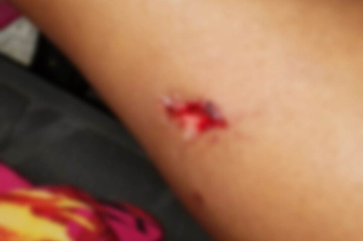 Mulher tem pedaço da perna arrancada durante briga em pagode