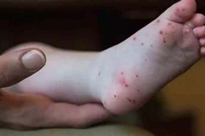 As erupções são dolorosas e se parecem às lesões típicas da varíola dos macacos
 -  (crédito:  CDC/Reprodução)