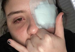 Jovem tem córnea queimada após olhos serem atingidos por 'loló' em festa