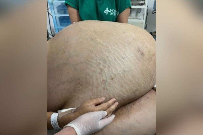 De acordo com a família da mulher, ela vivia com o tumor há cinco anos. Ela pesava 150 kg, destes, 46 eram do tumor - (crédito: Arquivo pessoal) De acordo com a família da mulher, ela vivia com o tumor há cinco anos. Ela pesava 150 kg, destes, 46 eram do tumor - (crédito: Arquivo pessoal)